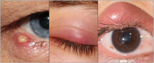 Difference between external stye, internal stye and chalazion.