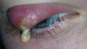 How to Get Rid of a Stye