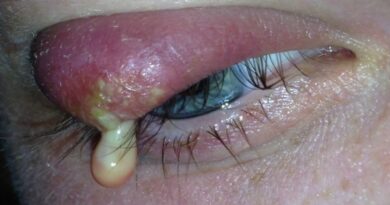 How to Get Rid of a Stye