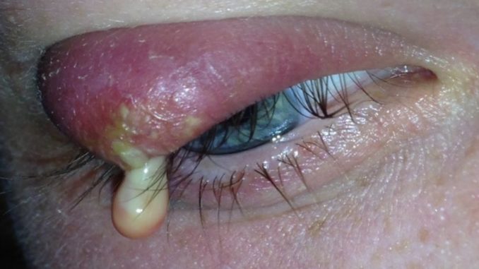How to Get Rid of a Stye How to Get Rid of a Stye