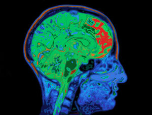 Parallel Recovery in a Bilingual Aphasic A Neurolinguistic and fMRI Study